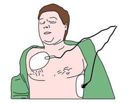 Defibrillointi - sydänlihassolujen kaoottisen sähköisen toiminnan pysäyttäminen tasavirtasähköiskulla - jos potilaalla on defibrilloitava rytmi (VF tai VT), defibrilloidaan kerran, jatketaan