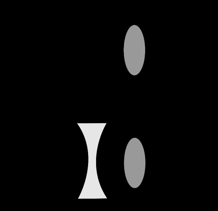 KUVIO 2. Valon taittuminen ja taittovirheen korjaaminen myooppisessa silmässä (Wikimedia Commons 2014b, viitattu 29.10.2015).