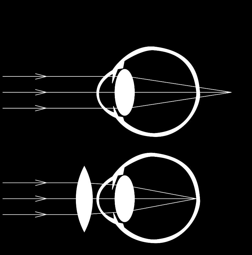 KUVIO 3. Valon taittuminen ja taittovirheen korjaaminen hyperooppisessa silmässä (Wikipedia 2014, viitattu 29.10.2015).
