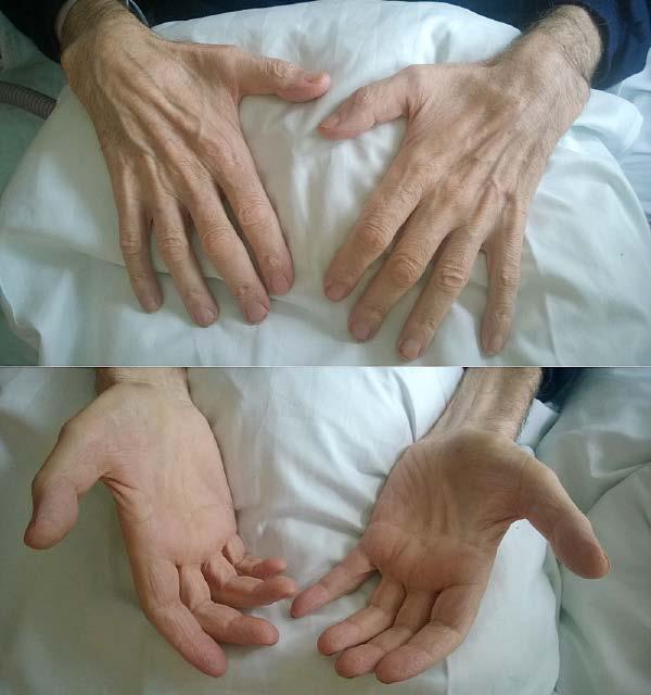 KUVA 1. Käsien lihasatrofia. 67-vuotias mies on sairastanut ALS-tautia alle vuoden. Hänellä todetaan käsien pikkulihasten surkastuminen ja taudille tyypillinen ns. split hand -ilmiö.