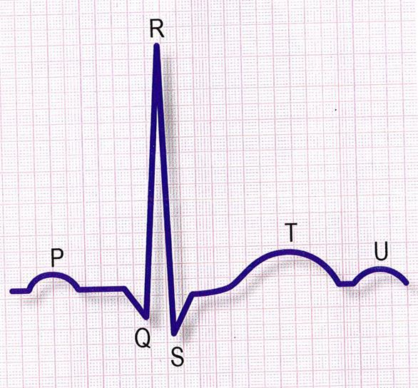 18 KUVA 4. Elektrodien sijoittelu (Elvytys 2016) Sydänfilmillä voidaan rekisteröidä sydämen sähköistä toimintaa. Sydämen normaali rytmi eli sinusrytmi koostuu kolmesta osiosta (kuva 5).
