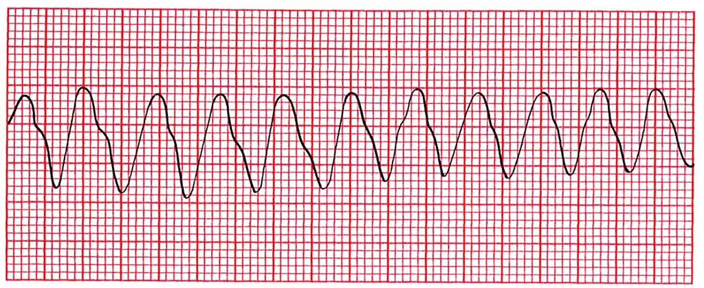 19 Defibrillaattori analysoi sydämen alkurytmin. Sydämen rytmi voi olla defibrilloitava tai ei-defibrilloitava. Defibrilloitavia rytmejä ovat sykkeetön kammiotakykardia eli VT ja kammiovärinä eli VF.