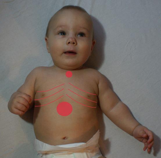 19 Jotta rintakehän liikkeet havaittaisiin huolellisesti, lapsen vaatteet on syytä riisua. Rintakehältä tarkastellaan liikkeiden symmetrisyyttä, syvyyttä sekä apuhengityslihasten käyttöä.