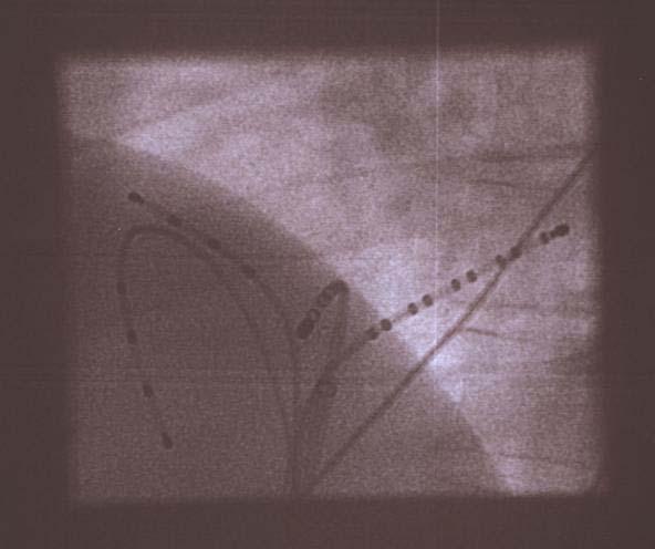 240/min Kapea QRS, joskus aberraatio