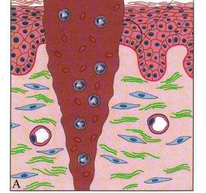 Sidekudosvaurion paraneminen - granulaatokudos Kuvat: Rubin et Farber: Pathology. Lippincott Raven A. Vaurio on täyttynyt verihyytymällä, dermiksessä ei reaktiota. B.