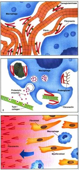 Samalla fibro-blastit/ myofibroblastit syntetisoivat pysyvämmän, typpi I kollageeni-perustaisen soluväliaineen. 4. Siivous jatkuu Samalla fibroblastit tuottavat uutta matriksia (Koll III). 5.