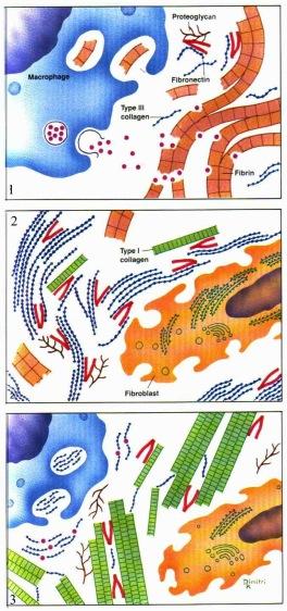Lippincott Raven Rasvasolut ja rasvakudos Lopulta fibroblastien ja myofibroblastien sekä kapillarien määrä vähenee ja paikalle on syntynyt runsaasti tyyppi I kollageenia sisältävä arpikudos.