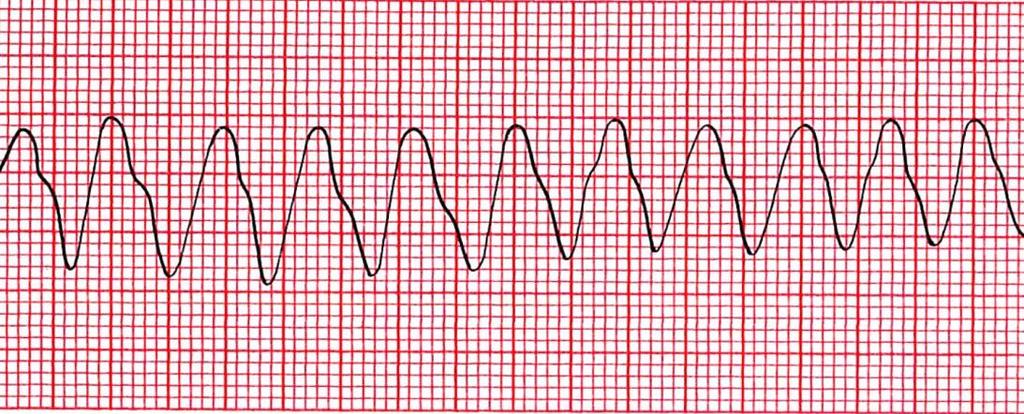 17 niiden anatomisen lähtökohdan mukaan eteis- tai kammioheilahduksiksi. EKG:n välittämä tieto sydämen sähköisestä toiminnasta sisältyy näiden aaltojen järjestykseen ja kestoon, sekä aaltojen muotoon.
