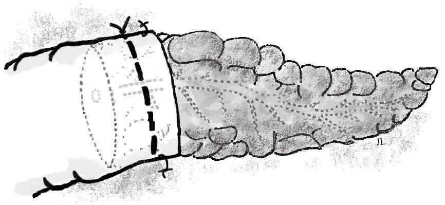 paikalleen 6-8 pito-ompeleella, jotka eivät kulje varsinaisen haimakudoksen kautta. Lopuksi sauma vielä tiivistetään kiristämällä ohutsuoleen asetettu tupakkapussiommel (15). Kuva 1.