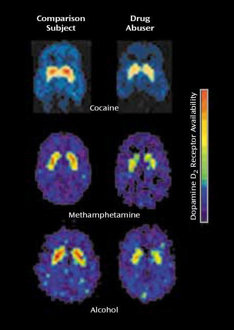 Pitkäaikainen päihdekäyttö: D2/3-dopamiinireseptorien määrän väheneminen accumbenstumakkeessa Aivojen mesolimbisen motivaatio- ja palkitsemisjärjestelmän