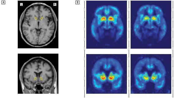 Accumbens-tumake: suurempi μ-reseptorien määrä alkoholisteilla Alkoholistit