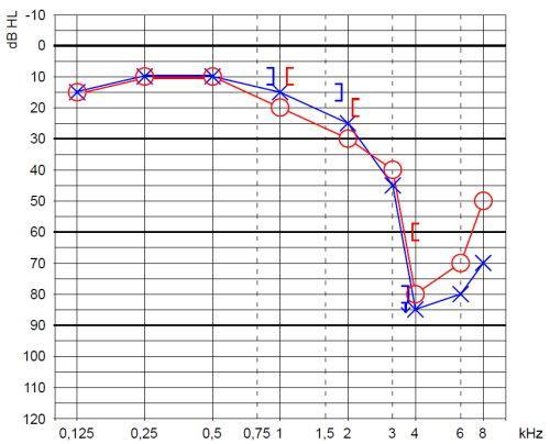 10 Kuva 2. Kuulokäyrä. Vasemmalla sensorineuraalinen kuulovika ja oikealla konduktiivinen kuulovika (Kokkonen, J. 2010. www.terveysportti.