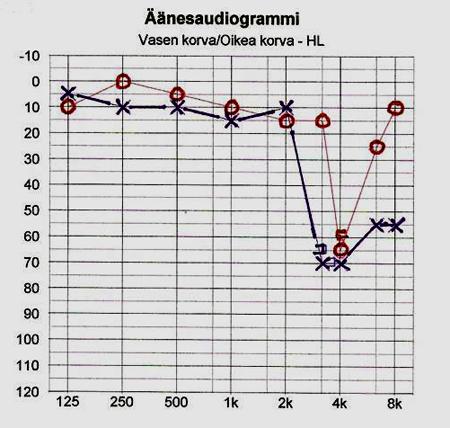 13 Kuva 3. Esimerkki tyypillisestä melun aiheuttamasta kuulokynnysmuutoksesta (www.kuuloliitto.