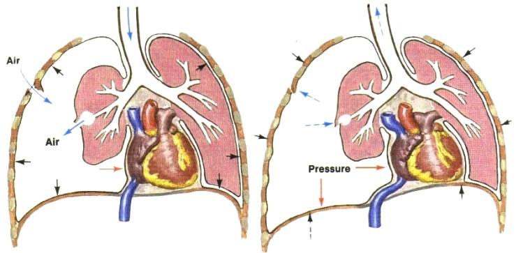 virtaus suuntautuu vain sisäänpäin ja läppämekanismi estää ulosvirtauksen niin kehittyy jänniteilmarinta, joka painaa myös toisen puolen keuhkon kasaan. enemmän.