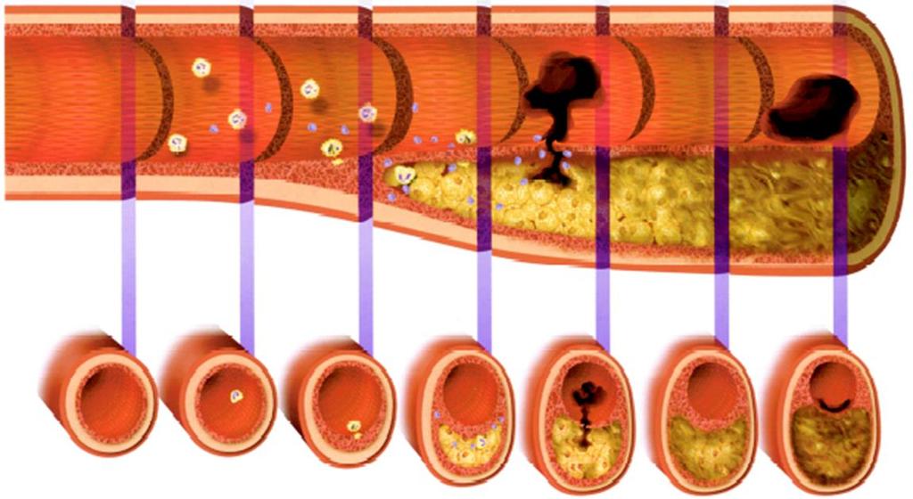 Valtimon ahtautuminen A I K A Tauti alkaa valtimoiden sisäpintaa verhoavasta ohuesta sisäkalvosta, jonka alle alkaa muodostua kertymä veren pahasta