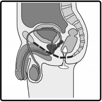 Kegel8 V for Men käyttöohje sivu 5 Jos käytät laitetta 1 tai 2 kertaa päivässä vähintään 3 kuukautta, lantion lihakset vahvistuvat.