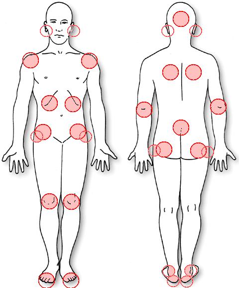 3 2 PAINEHAAVA Painehaavalla (pressure ulcer, pressure sore) tarkoitetaan ihon tai ihonalaiskudoksen paikallista vauriota, jonka on aiheuttanut paine, venyttyminen tai hankaus tai näiden tekijöiden