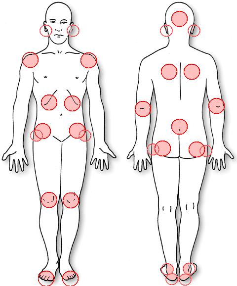 3 2 PAINEHAAVA Painehaavalla (pressure ulcer, pressure sore) tarkoitetaan ihon tai ihonalaiskudoksen paikallista vauriota, jonka on aiheuttanut paine, venyttyminen tai hankaus tai näiden tekijöiden