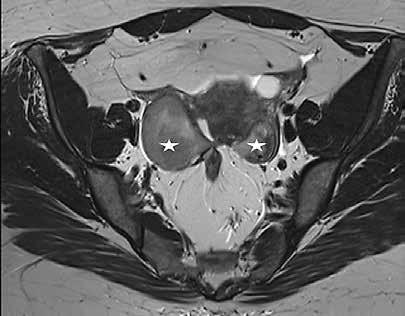 A B KUVA 1. Molemmissa munasarjoissa on endometriooma.