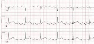 Rytmihäiriöt Eteislepatus Syntymekanismina eteisissä kiertävä sähköinen aktivaatiorintama EKG:ssä tyypillisesti F-aalto alaseinäkytkennöissä Kammiotaajuus johtumissuhteen mukaan (esim.