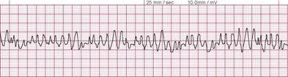 Rytmihäiriöt Kammiovärinä (VF) Kammiovärinässä kammioissa nopea järjestäytymätön sähköinen aktiviteetti Sydän ei pysty kierrättämään verta Oireena