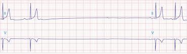 Rytmihäiriöt Sinusrytmi Sairaan sinuksen oireyhtymä (sick sinus syndrome) Sinussolmukkeen toiminta huononee ja aiheuttaa pulssin mataluutta Syndroomaan voi liittyä ajoittaiset nopeat tykytykset ja