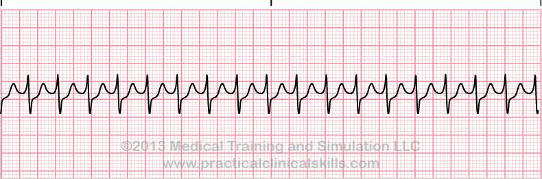 50. Oheisessa EKG-rytmitallenteessa sydämen rytminä on a. Asystole b. Eteistakykardia c. Eteisvärinä d. Kammiotakykardia e. Kammiovärinä f. PEA g. Sinustakykardia h.