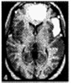 assosiaatioaivokuori =orbitofrontaalinen aivokuori) Kuva altapäin Lateraalinen kuva Vasemman
