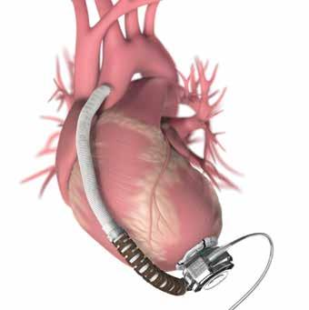 LVAD-hoitoa voidaan harkita vaikeaa kroonista sydämen vajaatoimintaa sairastaville potilaille, joilla ilmenee optimaalisesta lääkehoidosta huolimatta jatkuvia vaikeita vajaatoimintaoireita sekä