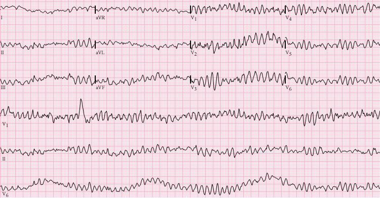 13 Kuvio 2: Kammiovärinä EKG:ssä (mukaillen Wikipedia) Kammiotakykardiassa sydän tekee vähintään 3 peräkkäistä kammiolisälyöntiä.