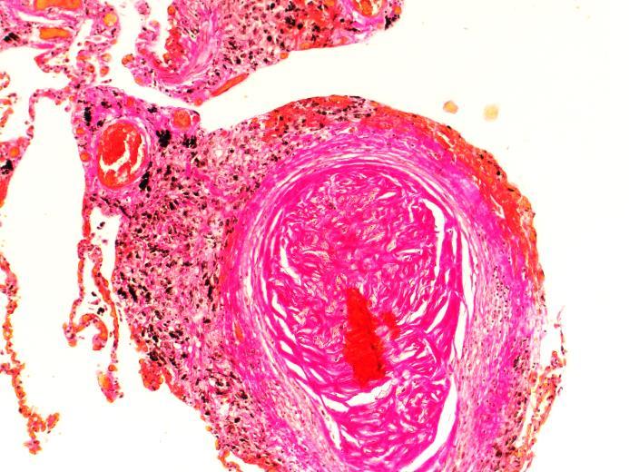 Mitkä muut kasvaimet voivat olla työperäisiä keuhkosyöpä silikoosin yhteydessä silikoosi: kvartsipölyn aiheuttama nodulaarinen fibroosi keuhkosyöpä kromi- tai nikkelialtistumisen