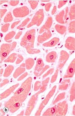 Histologian ja osin patologian termejä: Atrofisia luurankolihassoluja Atrofia ja hypertrofia Normaali sydänlihas Hypertrofinen vasen kammio suuret solut Atrofiset solut näyttävät ympäröiviä soluja