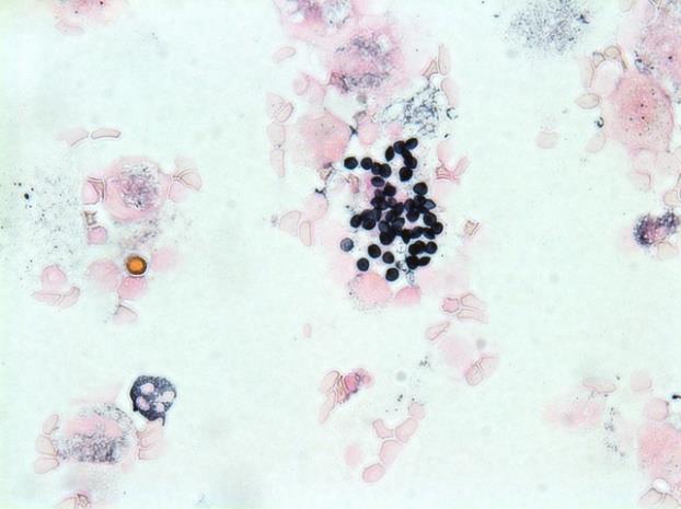 Nuolilla on osoitettu mustaksi värjäytyneet Pneumocystis jiroveciit.