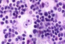 T-solulymfoomat 10 % 25 % Levinneisyysluokittelu Ann Arbor Stage I: Yksi imusolmukealue Stage II: Useampi imusolmukealue samalla puolella palleaa Stage III: Imusolmukkeet eri puolilla palleaa ja