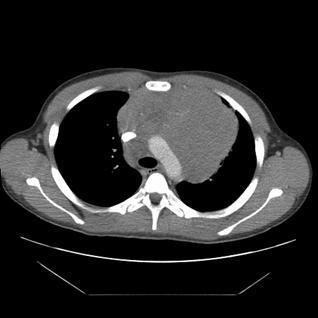 10-20% non-hodgkin-lymfoomista Heterogeeninen tautiryhmä Ihon affiisio ja ekstranodaalinen leviäminen Leukemisoituminen Monimuotoinen immunofenotyyppi Usein yleisoireita