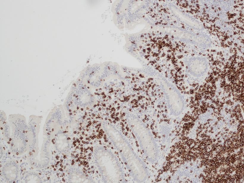 19 KUVA 3. CD2-värjäys (Iina Puuppo & Viktoria Pälvi 2015). CD3-antigeenia esiintyy T-solujen ulkopinnalla. Antigeenia on myös kateenkorvassa esiintyvissä T-lymfosyyttien esiasteissa.