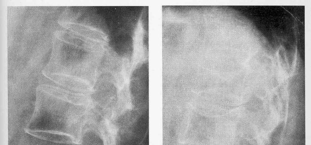 osteoporoosin syitä kalsiumin puute ravinnossa, kaikenikäiset!