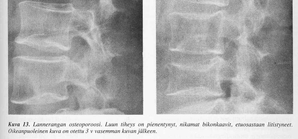 vanhuuteen liittyvä luun haurastuminen taulukko kirjasta Lamberg A-B ym.(toim.