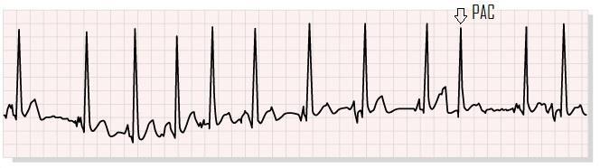 Answer all three questions. 1. The following IIR derivative filter is given in z-transformed form. (6p) H(z) = Y(z) X(z) = 1000[ 1 z 1 1 0.995z 1] a.