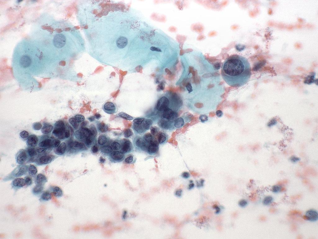 Endometriaaliset solut Tiivis, kohesiivinen ryhmä N/C ratio suurentunut Pienet tumat, pienet solut
