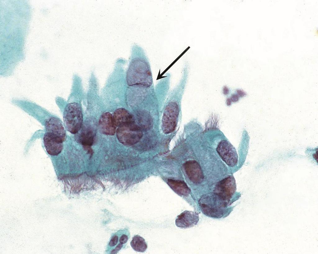 Tubaalinen metaplasia Pseudokerrostuminen Suurentuneet, pidentyneet,