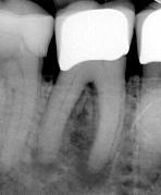 Juurihoito on apikaalisen periodontiitin hoitoa ja ennaltaehkäisyä 4 Pre-operative Follow-up 1 year Post-operative Koska juurikanavan infektio on hampaan apikaalisen