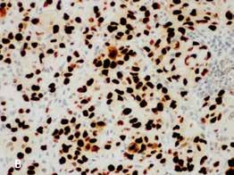 KUVA 3. Välikarsinan imusolmukemetastaasin tutkimus. A) Perusvärjätyssä HE-leikkeessä todetaan solidisti järjestäytyvä karsinooma, jossa on adenokarsinoomalle ominaisia sinettisormussoluja (nuolet).