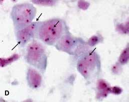 RAS (rat sarcoma) geenin mutaatioita, joita esiintyy noin neljäsosassa adenokarsinoomista, ei rutiinimaisesti tutkita muuten kuin NGS:llä.