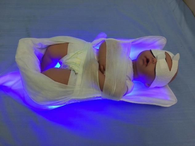 Hoito toteutetaan kannettavalla sinivalohoitolaitteella, joka mahdollistaa lapsen sylissä pitämisen valohoidon aikana.