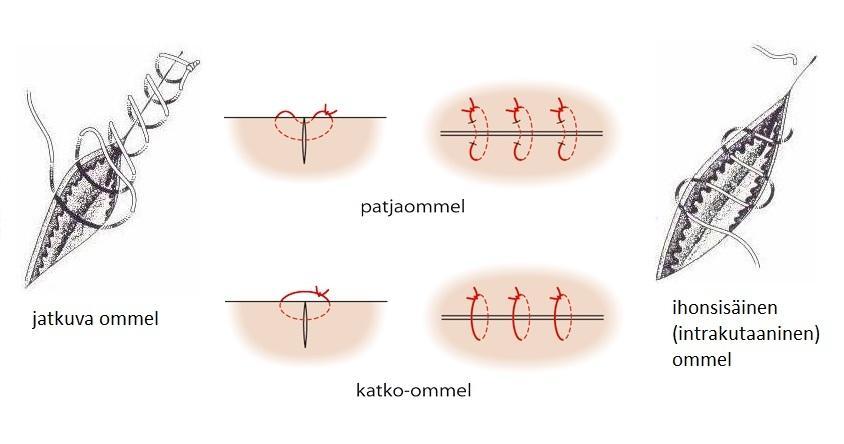 19 ko-ommel, patjaommel, intrakutaaniommel ja jatkuva ommel. (Virkki 2010a.) Haavan sulkemiseen voidaan käyttää myös haavahakasia, eli aggraffeja (Hietanen ym. 2005, 106).