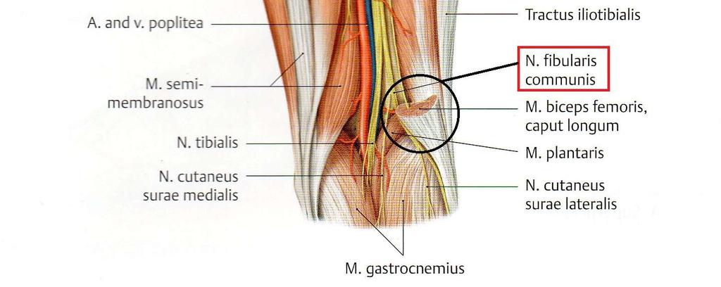 Lisäksi hermo voi jäädä pinteeseen polvitaipeessa soleuslihasten kiinnittymiskohdan alueella tai plantaarihermojen kautta jalkaterän mediaalisivulla isovarpaan loitontajalihaksen