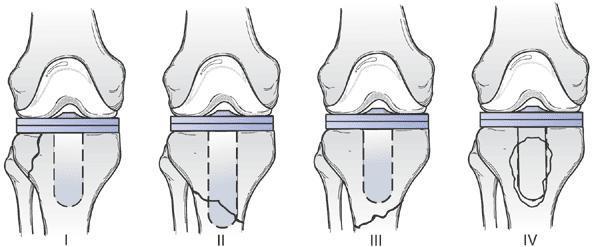 Tibia: