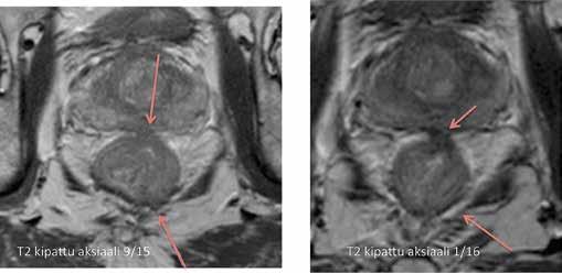 A B KUVA 5. Potilaan 2 leikkausta edeltävä ja vaste-mk. T2-painotteiset suolen seinämän suhteen kohtisuorat leikkeet kasvaimen kohdalta. Primaarikasvain läpäisee useassa kohdassa lihaskerroksen.
