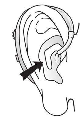 1 BTE-kuulokojeen yksilöllinen korvakappale HOITO-OHJEET Pidä kuulokoje puhtaana, jotta se toimisi oikein. Katso yleisohje alla. Mallikohtaiset hoito-ohjeet on käyttöohjeessa. harjaamalla 1.